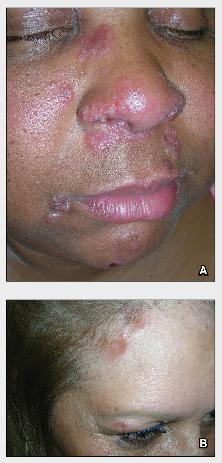 Pink, elevated, granulomatous, indurated plaques on the face